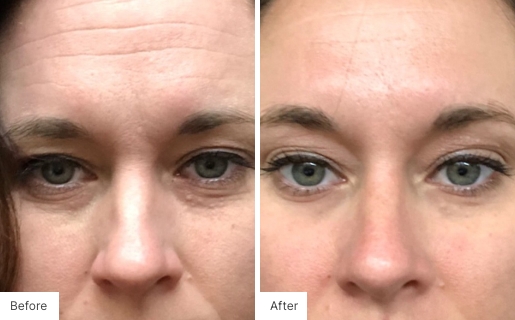5 - Before and After Real Results photo of a woman's face.
