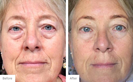9 - Before and After Real Results photo of a woman's face.