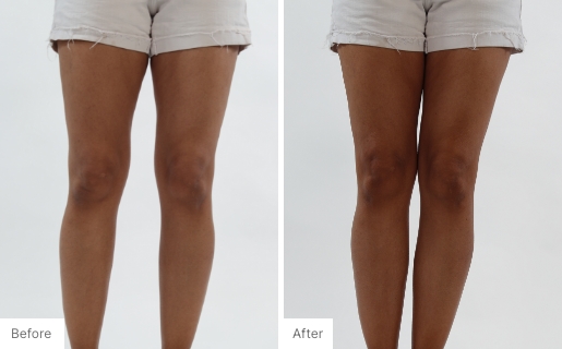 9 - Before and After Real Results of a woman's legs from using the 3-in-1 Self Tanning + Sculpting Foam.